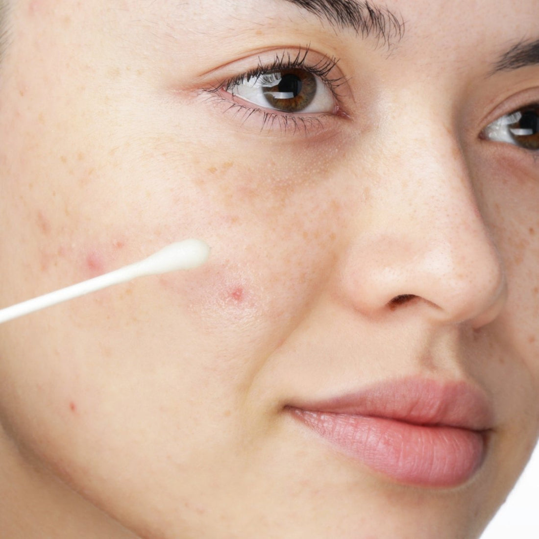 How to Remove Red Marks on Your Face: Causes, Treatments & Tips