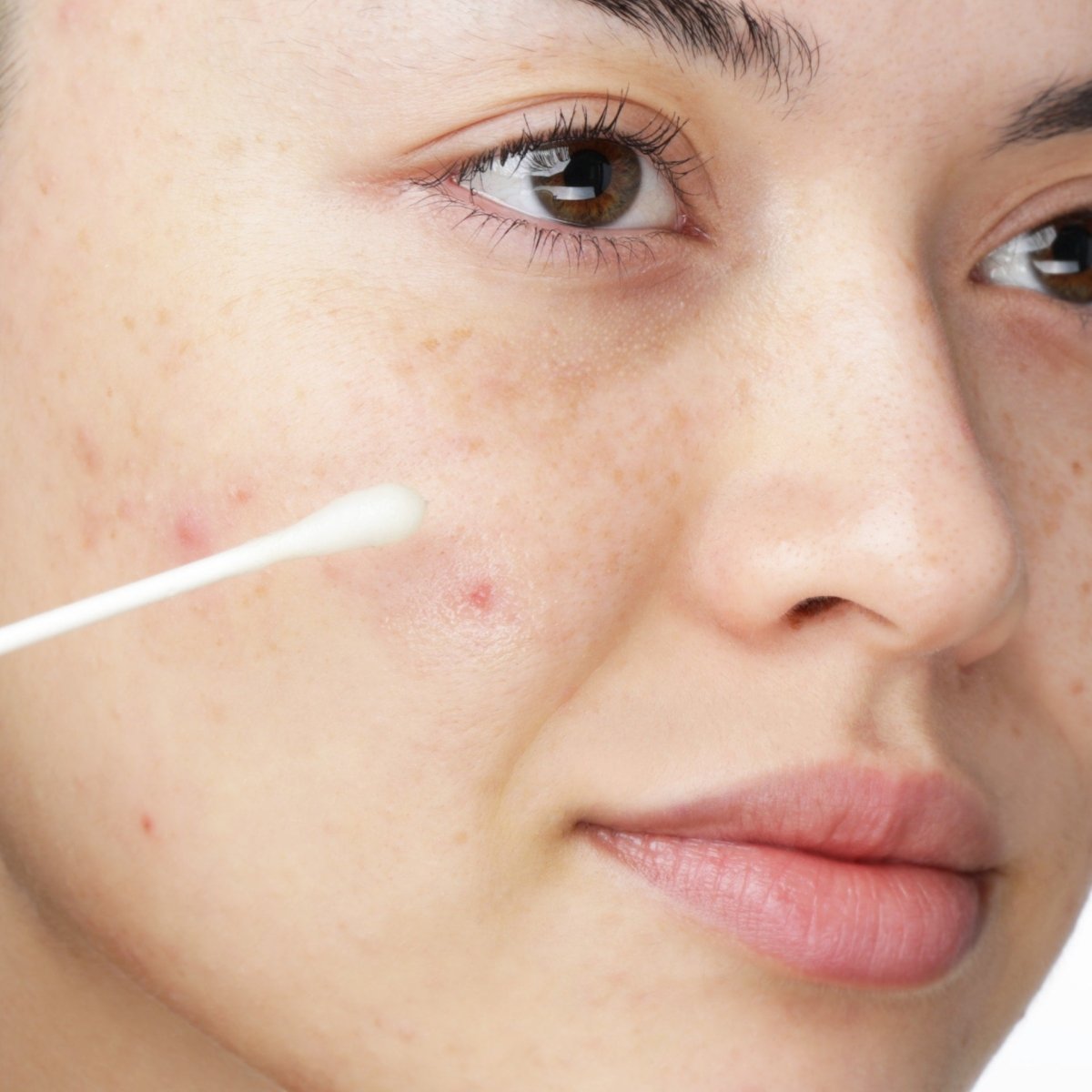 How to remove red marks from face - acne scar treatment and skin healing routine for clear even skin tone