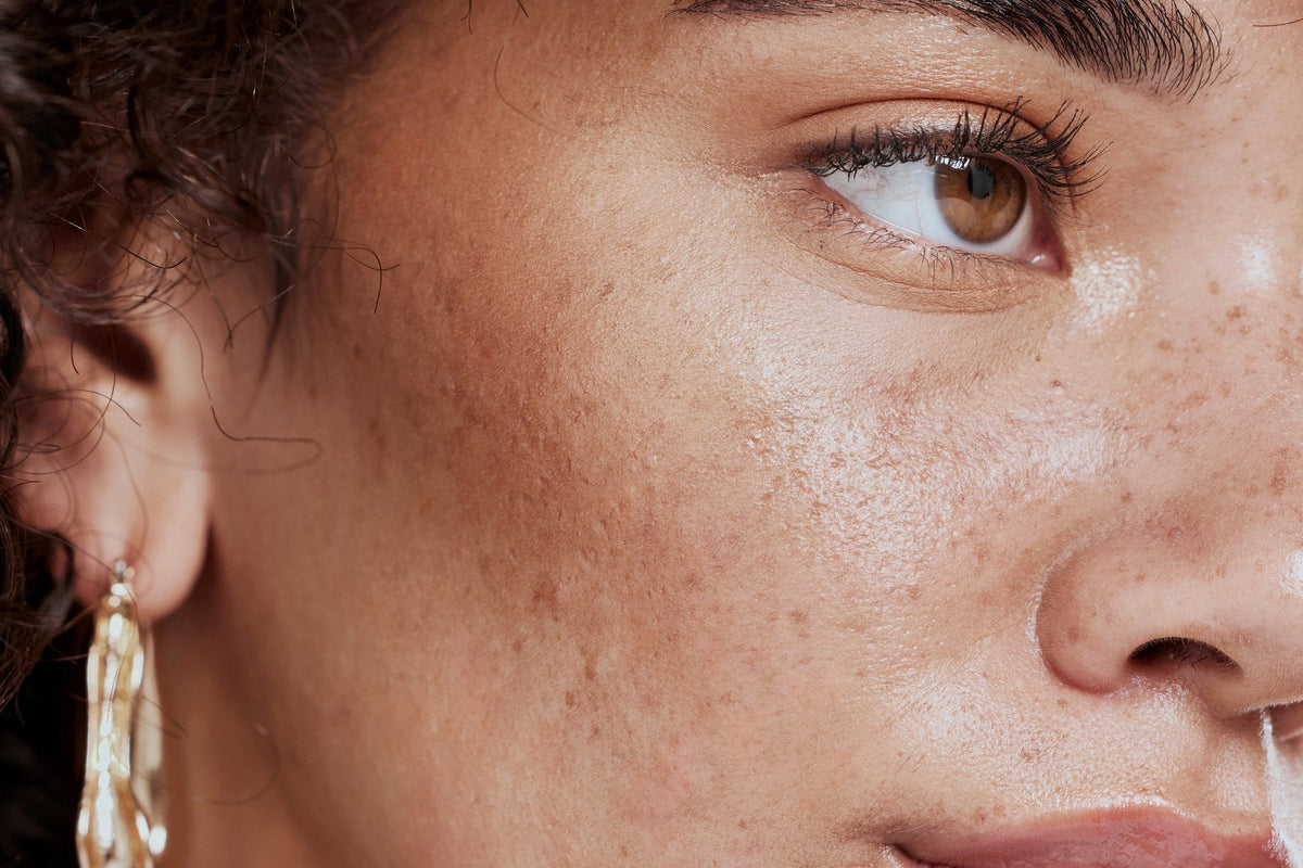 Close-up of a face showing natural freckling and uneven tone