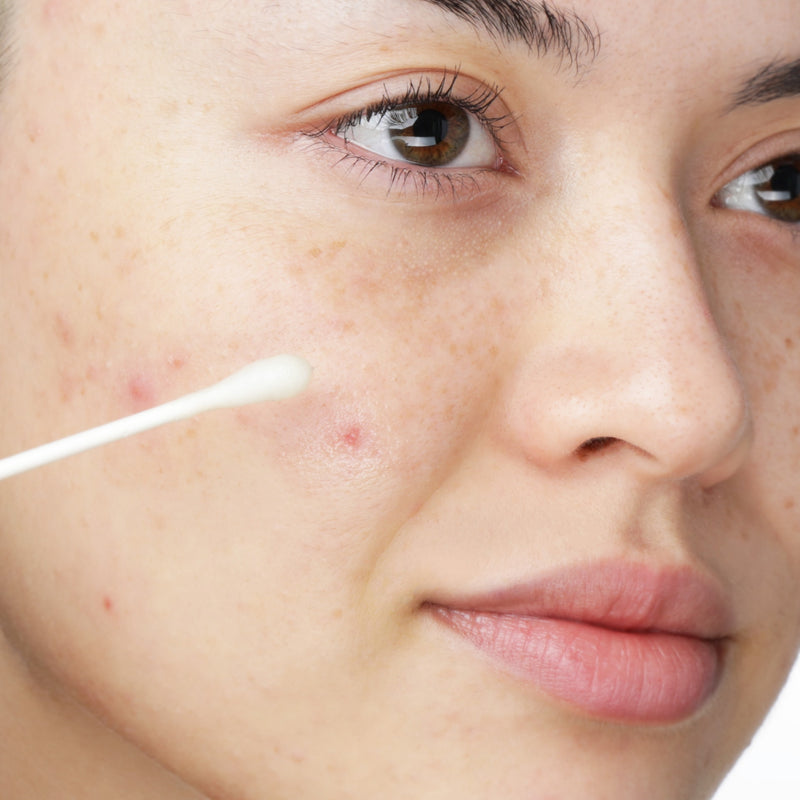 Cotton bud dabbing a product onto a small spot on the cheek